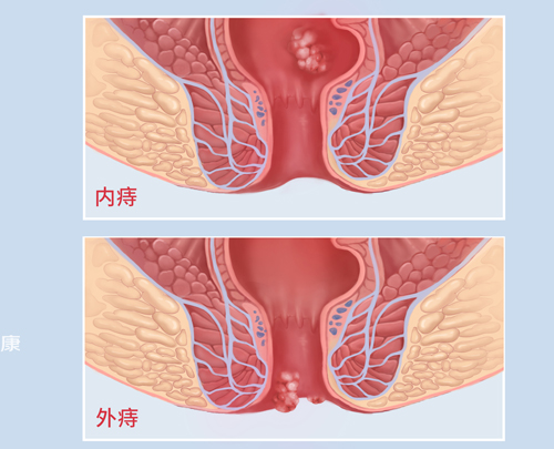 痔瘡